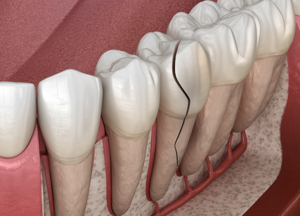 Mouth with a tooth root fracture at Peak Endodontics in Covington, WA Mouth with a tooth root fracture at Peak Endodontics in Covington, WA