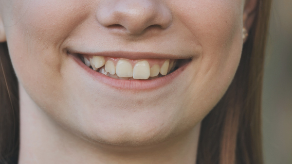 Smiling mouth with displaced teeth at Peak Endodontics in Covington, WA